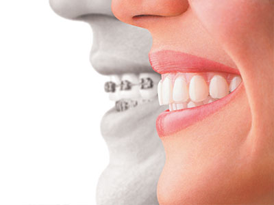 Almaden Valley Smile Design | Dentures, Full Mouth Reconstruction and Dental Cleanings   Exams